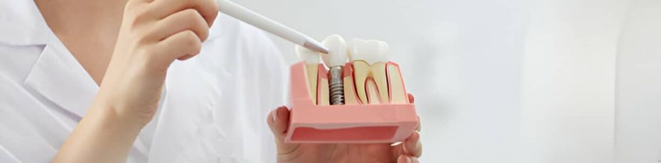 Are Dental Implants Worth It? What Patients in Surrey Need to Know